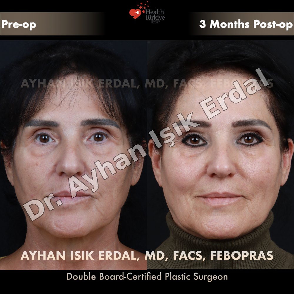 Facial fat transfer before and after — front view, 3 months post-op, patient of Dr. Ayhan Işık Erdal